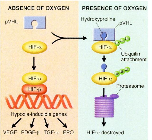 5 Fonte: George et al 19 Figura 3 - Ilustração do papel da proteína VHL (pvhl) na ausência e presença de oxigênio A superexpressão de VEGF explica o extraordinário componente capilar das neoplasias