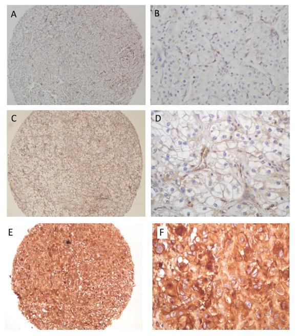 34 Figura 13 A e B) Análise de imuno-histoquímica escore 0 de AXL de um paciente com carcinoma de células renais tipo células claras, tecido tumoral renal. A) 100X; B) 400X.