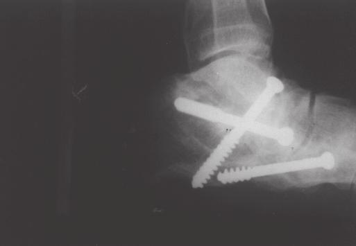 4 Radiografia em perfil pré-operatória de paciente com seqüela de poliomielite e deformidade em eqüino do pé parafuso talocalcaneano,