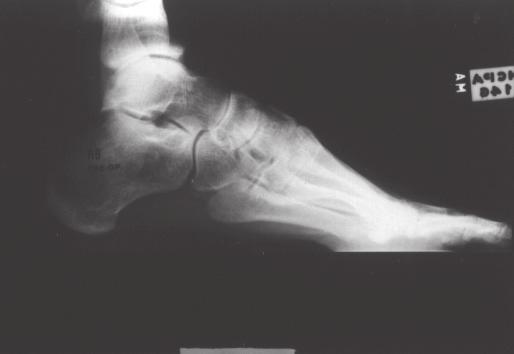 DISCUSSÃO O objetivo da tríplice artrodese é a obtenção de um pé plantígrado, estável e com pouca ou nenhuma dor.