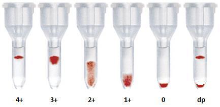 Negativo - ou 0 Faixa de glóbulos vermelhos no fundo da coluna, sem aglutinações visíveis +/- Escassas aglutinações de tamanho pequeno na metade inferior da coluna 1+ Algumas aglutinações de tamanho