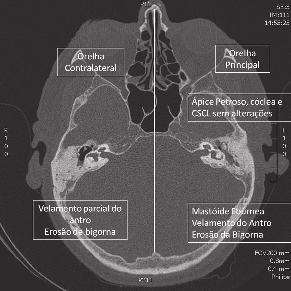 Alguns achados indicam presença de OMC mais agressiva. A Tabela 4 descreve os achados para estruturas comumente afetadas. Tabela 4. Sinais radiológicos de complicação no osso temporal da orelha contralateral.