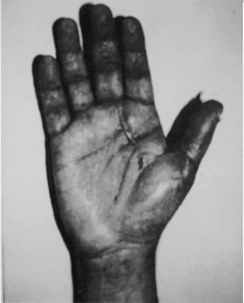 A cicatriz na região palmar e no dedo médio demonstra a via de acesso para a transferência da artéria digital radial do dedo