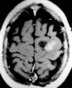 nodular após o contraste A Figura 3 Oligodendroglioma A,B: Cortes de tomografia computadorizada sem e com contraste evidenciando