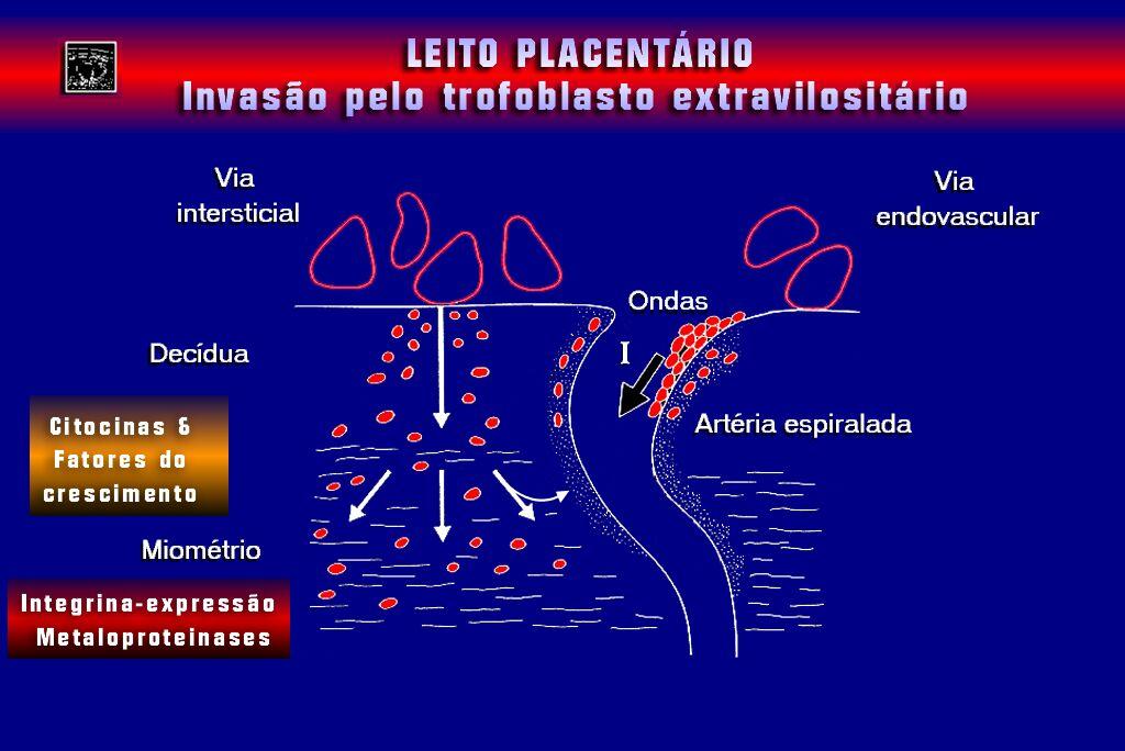 2. Revisão da Literatura 54 Figura 4: Leito placentário invasão pelo trofoblasto extravilositário Sonografia Botafogo RJ) (Ultra- Figura 5: Leito placentário invasão pelo trofoblasto extravilositário