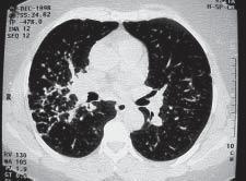 Pulmão RJ vol.14(2) 2005 Figura 2 TCAR do tórax: espessamento dos septos interlobulares à direita. Figura 5 TCAR do tórax evidenciando o comprometimento predominantemente axial dos pulmões.