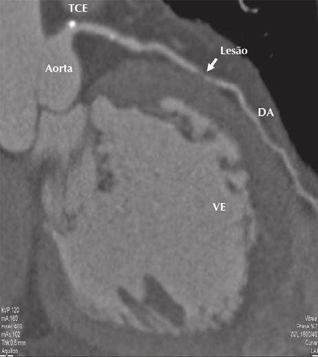 Figura 4 - Angiotomografia coronária demonstrando feixes musculares envolvendo o terço médio da artéria descendente anterior, com profundidade discreta, e imagem sugestiva de lesão estenosante nesse