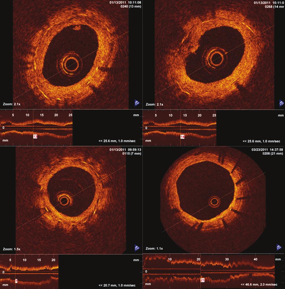 416 Rev Bras Cardiol Invasiva. A B C D Figura 1 - Imagens de tomografia de coerência óptica em corte transversal de coronárias porcinas com stents farmacológicos.