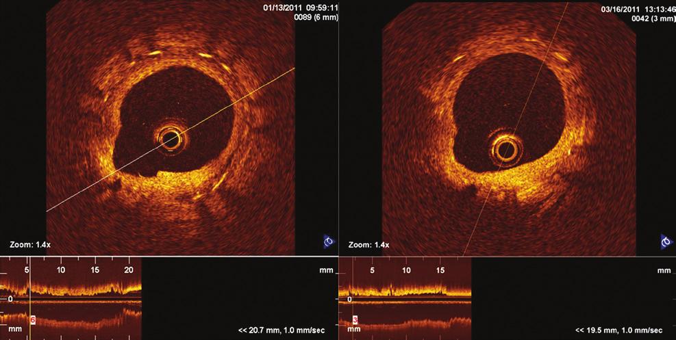 417 A B Figura 2 - Imagens pareadas de tomografia de coerência óptica em corte transversal do stent Inspiron implantado na artéria descendente anterior aos 28 dias (A) e aos 90 dias (B).