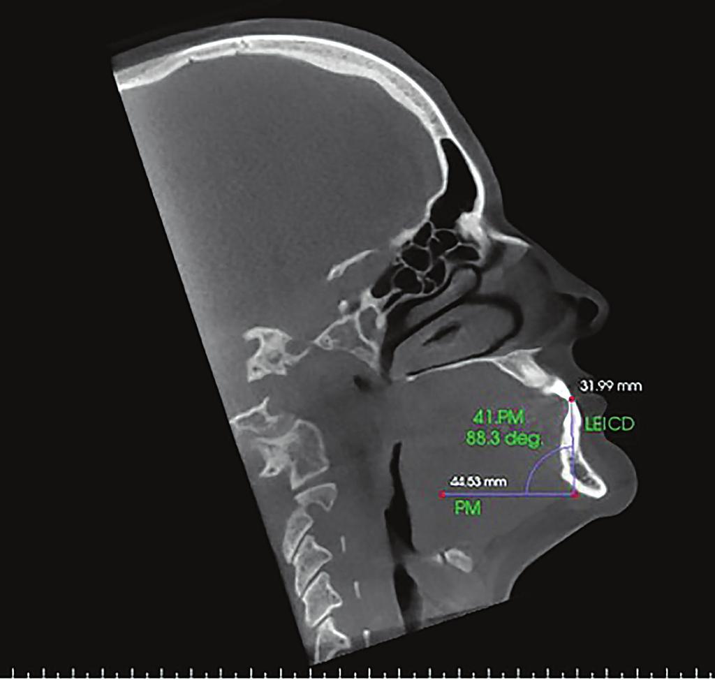 Figure 7 - Sagittal slice with the individual s head positioned so as the horizontal reference line was superimposed to the mandibular plane for measurement of mandibular right central incisor