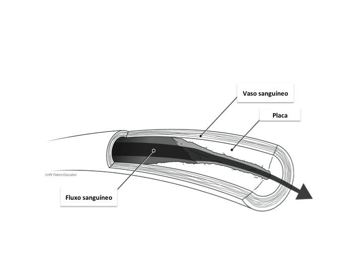 (veja figura 2): 1. Progredir (ficar maior, piorar) 2. Estabilizar (ficar do mesmo tamanho) 3.