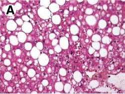 Diagnóstico de NAFLD Caracterizada por excessivo acúmulo de lipídeos (ESTEATOSE principalmente macrovesicular) na ausência de uso significativo de álcool