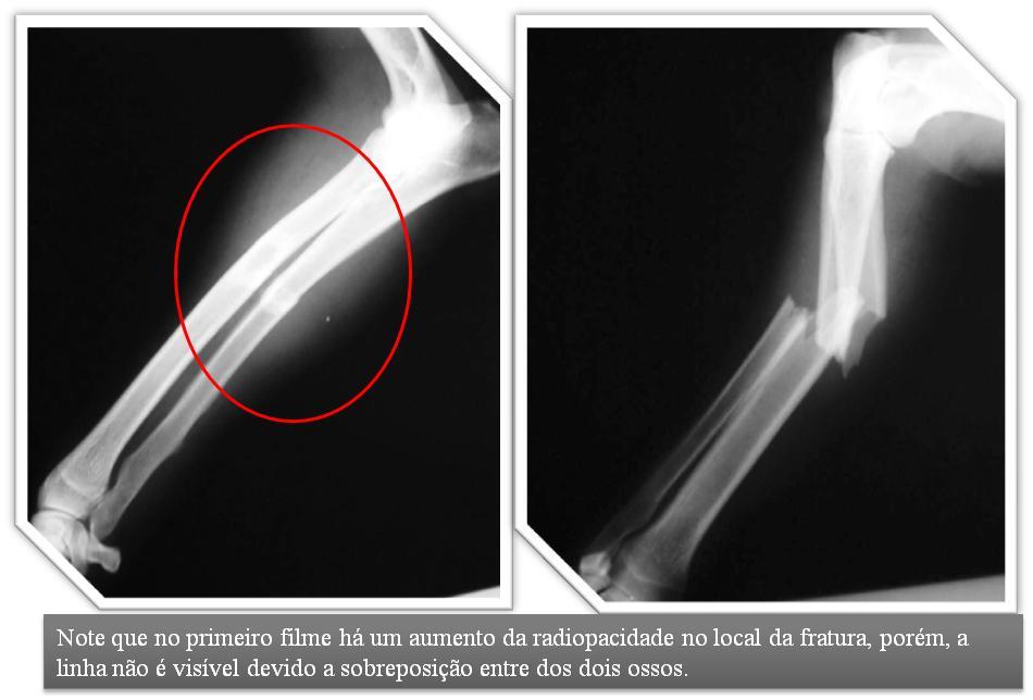 Radiologia do Esqueleto Apendicular Fraturas e complicações Profa. Tilde Rodrigues Froes - UFPR PRINCIPIOS DA TÉCNICA Sempre realize no mínimo duas projeções, com feixes a 90 graus.