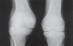 L.R.L. PACHECO, P.G.C. ALENCAR, G.A. YOSHIYASU & M.T. VEIGA A B Fig. 1 Aspecto radiográfico em incidência ântero-posterior (A) e perfil (B) dos joelhos em um paciente hemofílico de 18 anos de idade.