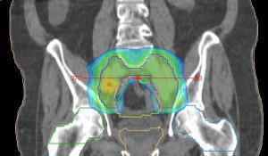 Adenocarcinoma de Próstata