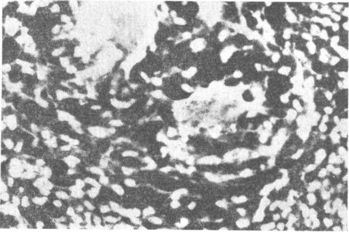 O exame histopatológico de uma das lesões veio completar a documentação do caso e revelou: Figura 4 "N.º 53.350 Intensa hiperplasia da epiderme.