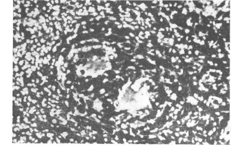 CROMOMICOSE E LEPRA 95 permite fixar o diagnóstico de cromoblastomicose. No interior de algumas células histiocitárias encontram-se bacilos álcoolácido-resistentes, granulosos. (a.) Dr.