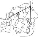 2 graus. Interpretação: Ângulo aumentado indica que o palato está inclinado no sentido anti-horário e a mordida aberta esquelética é devida à maxila.