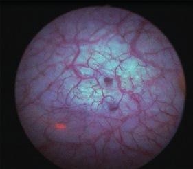 O diagnóstico fotodinâmico O diagnóstico fotodinâmico (PDD) permite uma apresentação precoce de tumores malignos não visíveis a olho nu e, por isso, uma melhoria do prognóstico para o paciente.