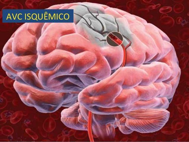 Definição Episódio de disfunção neurológica, geralmente focal, de instalação súbita ou rápida evolução, causada por infarto em território do cérebro, cerebelo ou tronco encefálico irrigado por