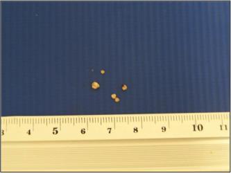 Urolitíase por cistina... Quinze dias após, foram realizados raio-x e ultrassonografia abdominal, observando-se microcálculos na bexiga e rim e na massa pancreática.