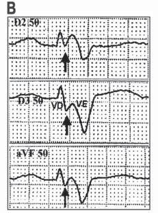 provável que as duas frentes de onda ou tenham colidido no SIV ou o impulso originado na área septal direita, após sua propagação septal D E, tenha encontrado a musculatura do VE em período