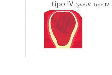 Plataforma Switch; Plataforma Platform. Plataforma. Indicated for type III and IV;.