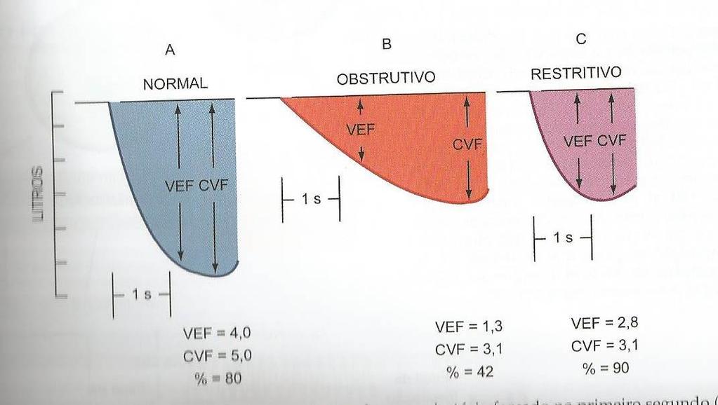 VEF volume expiratório forçado em 1 s CVF capacidade vital forçada a b FEF(25-75%) = 3,5 L.