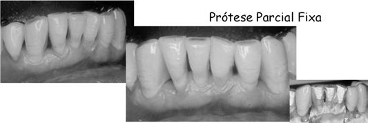 Prótese Parcial Fixa