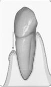 regiões do próprio dente: Colo ou região cervical terço