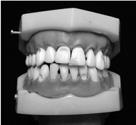 Classificação quanto às regiões do próprio dente: terço mesial terço distal terço médio