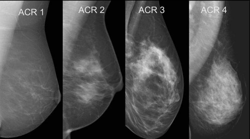 DENSIDADE MAMÁRIA Pode já ter ouvido falar sobre a importância da densidade mamária numa mamografia, que surgiu como um fator de risco para o cancro da mama em mulheres.