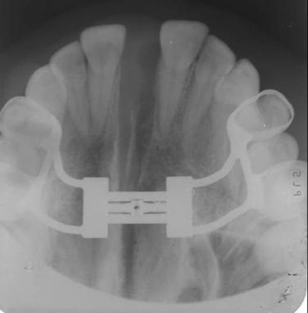 Revista Eletrônica da Faculdade de Odontologia da FMU, volume 2, número 3 3 Figura 2 - Radiografia oclusal da maxila após o procedimento de expansão maxilar.