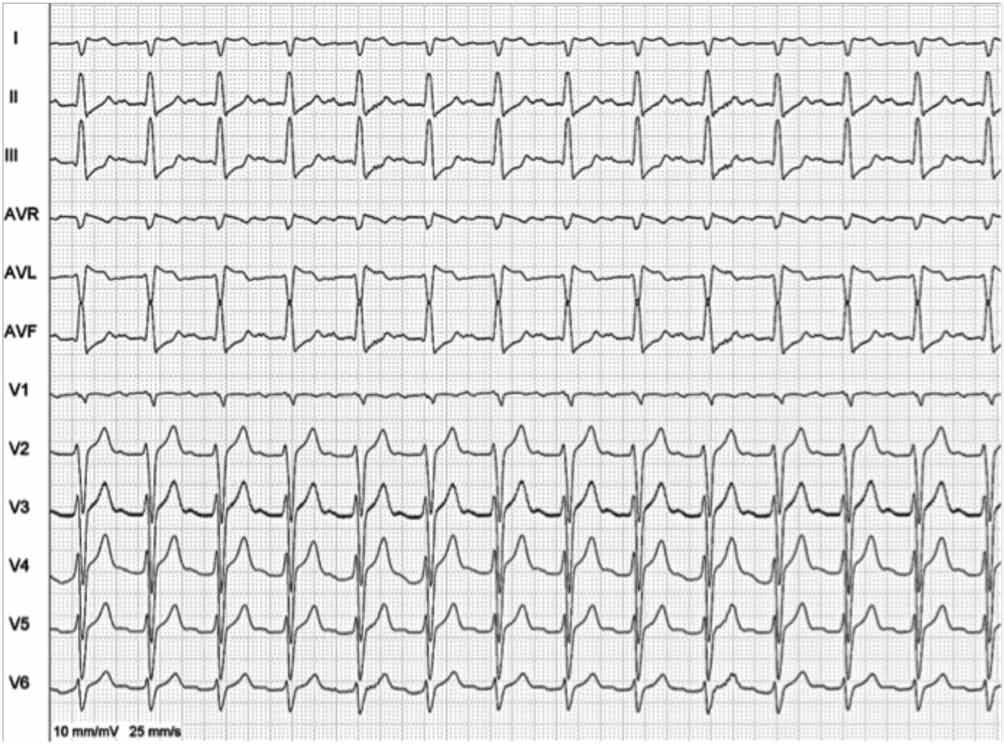 Rev Bras Cardiol. 2011;24(5):326-330 de taquicardia com QRS largo que foi revertida com amiodarona venosa.