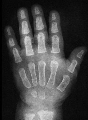 imagens de radiografias carpais, como a mostrada na Figura 1.