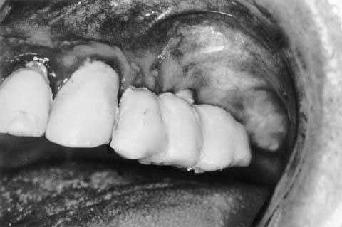 Fig.1: Prótese com 6 anos em paciente com higiene bucal deficiente, sem controle e manutenção há 4 anos. Observar áreas gengivais com inflamação intensa.