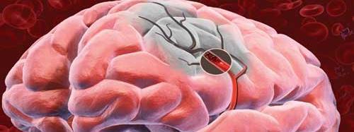ACIDENTE VASCULAR CEREBRAL (AVC) O acidente vascular cerebral, também conhecido como derrame, ocorre quando há um entupimento ou um rompimento
