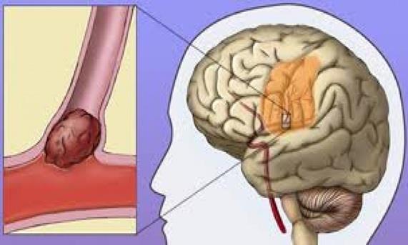 ACIDENTE VASCULAR CEREBRAL ISQUÊMICO O Ataque Isquêmico Transitório (AIT) se caracteriza por um entupimento passageiro em um dos vasos sanguíneos, mas que não chega a causar uma lesão cerebral.