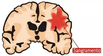irritativa por conta do contato do sangue com o parênquima nervoso (tecido cerebral com maior função).