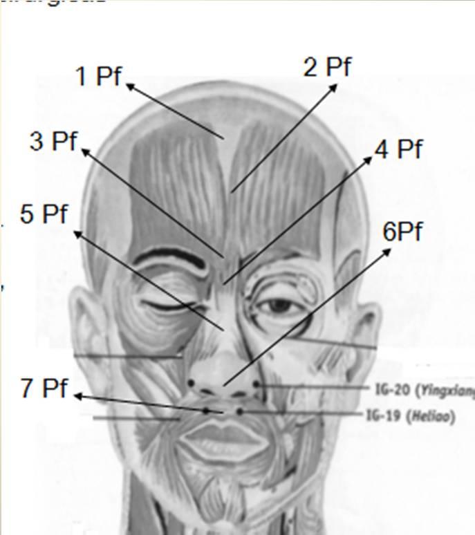 PONTOS 1 Pf- Nome: Crânio-Face ; Localização: linha sagital média da cabeça, região frontal, meio cun abaixo da inserção de cabelo.
