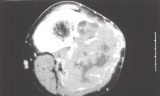 TUMOR DE CÉLULAS GIGANTES Fig. 4 Tomografia computadorizada de invasão articular tibiofibular proximal (paciente nº 17) Fig.