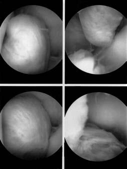 Em 1941, Jaffe et al propuseram o nome de sinovite vilonodular pigmentada, agrupando lesões que mostravam estroma fibroso, deposição de pigmentos, infiltração histiocitária e células gigantes em