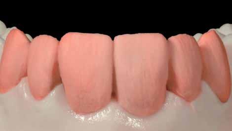 32 Dente confeccionado em Dentina. Fig. 30 Com poucos passos simples são obtidos excelentes resultados individuais.