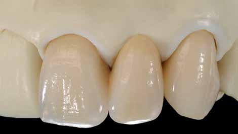 70 Luz transmitida Definição dos componentes Matrix Dentina de Mamelo MD; Dentina Secundária SD Massas com as quais