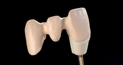 Com ela, podem ser recobertas áreas escuras (substância dental manchada) ou alterar luminosidade e transparência das Massas HM e LM.