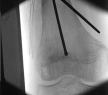 endomedular Figura 7 Resultado final após osteotomia e fixação com cavilha endomedular utilização de cravo de Steinmann introduzido anteroposteriormente ao nível do fémur distal para alinhamento