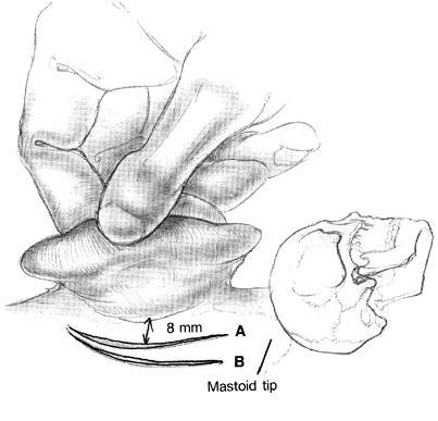 Mastoidectomia Simples Abordagem retro-auricular Forame