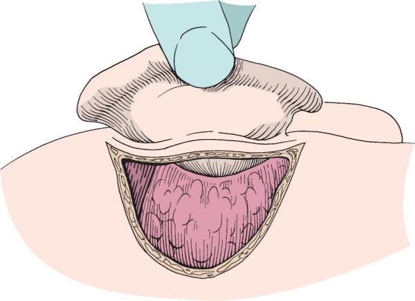 Mastoidectomia simples A incisão é feita na pele e subcutâneo, exponda a fáscia