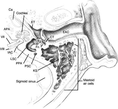Anatomia VII, sétimo nervo craniano; VIII, oitavo nervo craniano; APA, ápice petroso anterior; Ca, artéria carótida; CT, corda do tímpano; EAC, canal auditivo externo; ET,