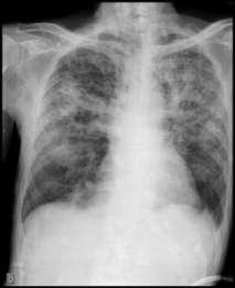 Até às 16 horas a radiografia simples de tórax não havia sido vista pelo solicitante, e nem mesmo o radiologista alertou o médico sobre o pneumotórax.